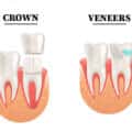 Veneers vs Crowns: Differences & Similarities – Which One Is Better for You?