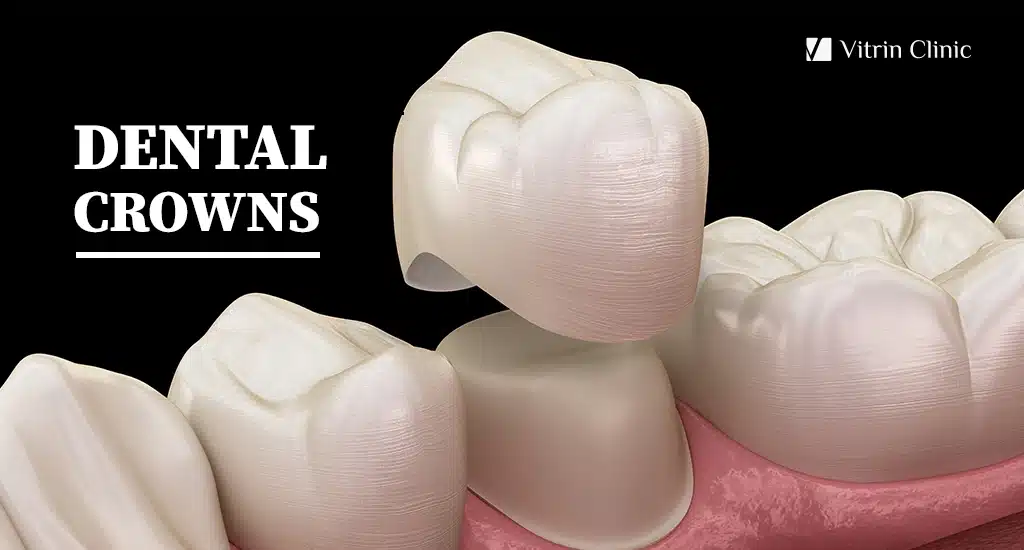 DENTAL CROWNS in Turkey - Vitrin Clinic