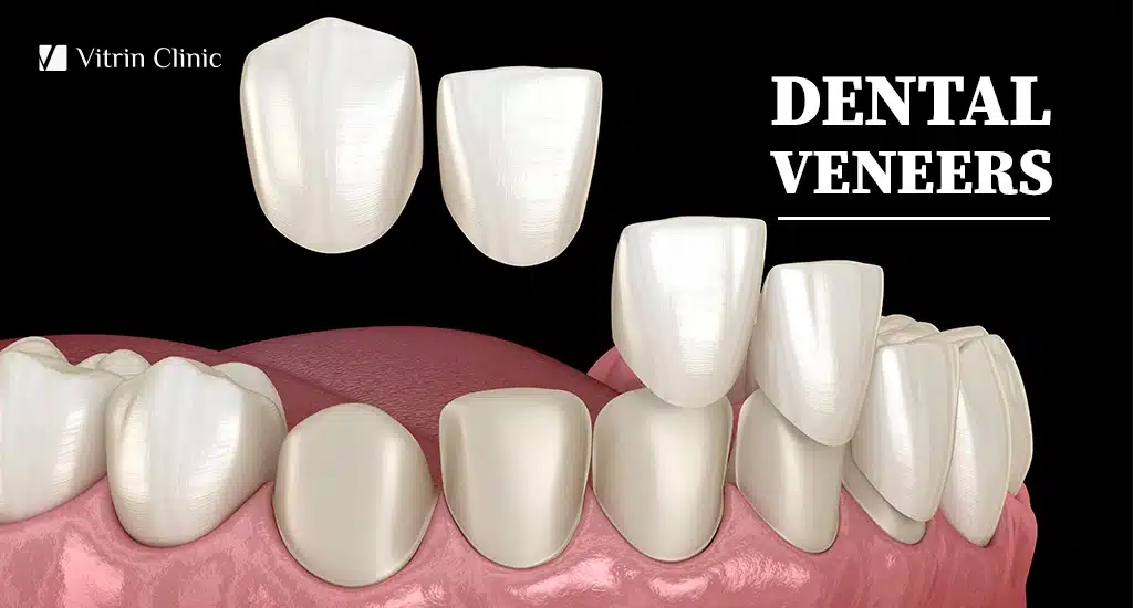 Dental Veneers in Turkey - Vitrin Clinic