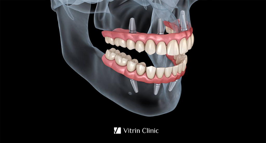Implants dentaires complets