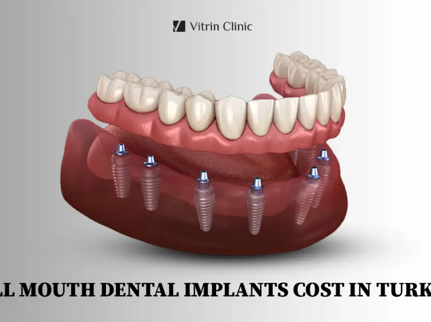 full mouth dental implant