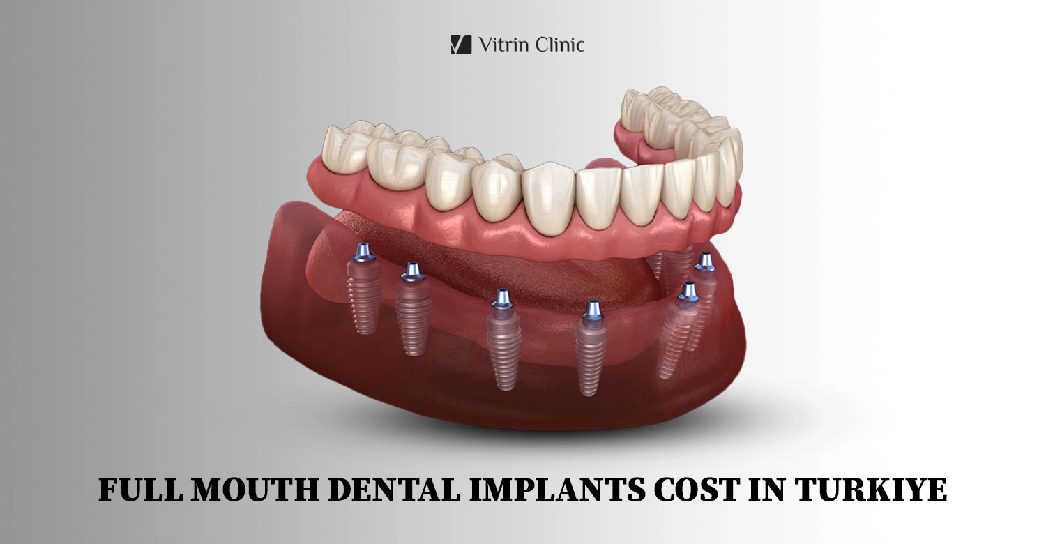 full mouth dental implant