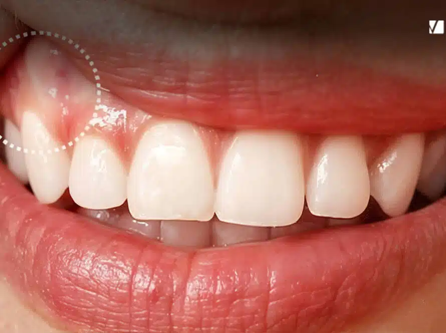White Gums