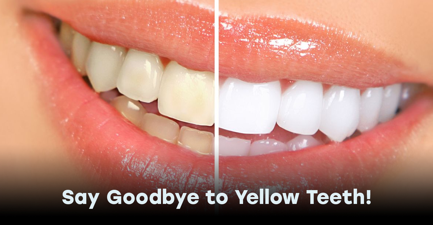 Yellow Teeth in Turkey 2025