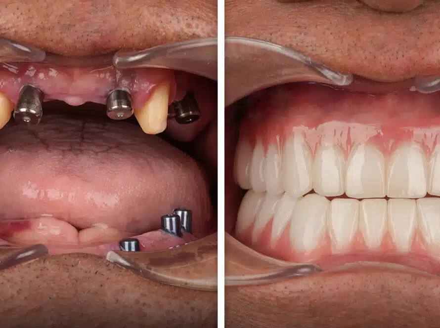 All-on-4 Dental Implants in Turkey Procedure, Prices & Why Choose Vitrin Clinic