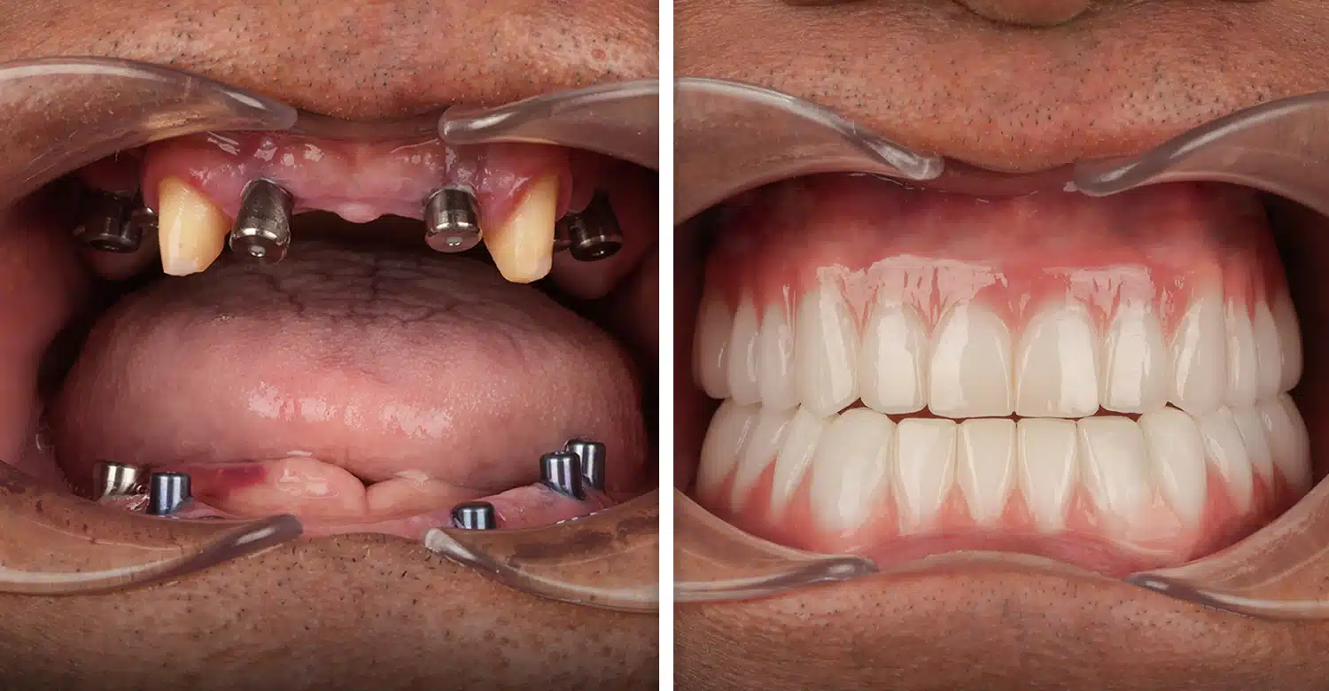 All-on-4 Dental Implants in Turkey Procedure, Prices & Why Choose Vitrin Clinic