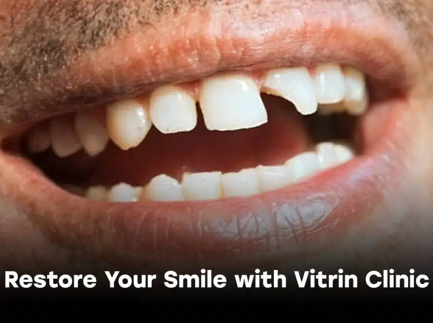 Traitement des dents cassées à Istanbul : retrouvez le sourire avec la clinique Vitrin