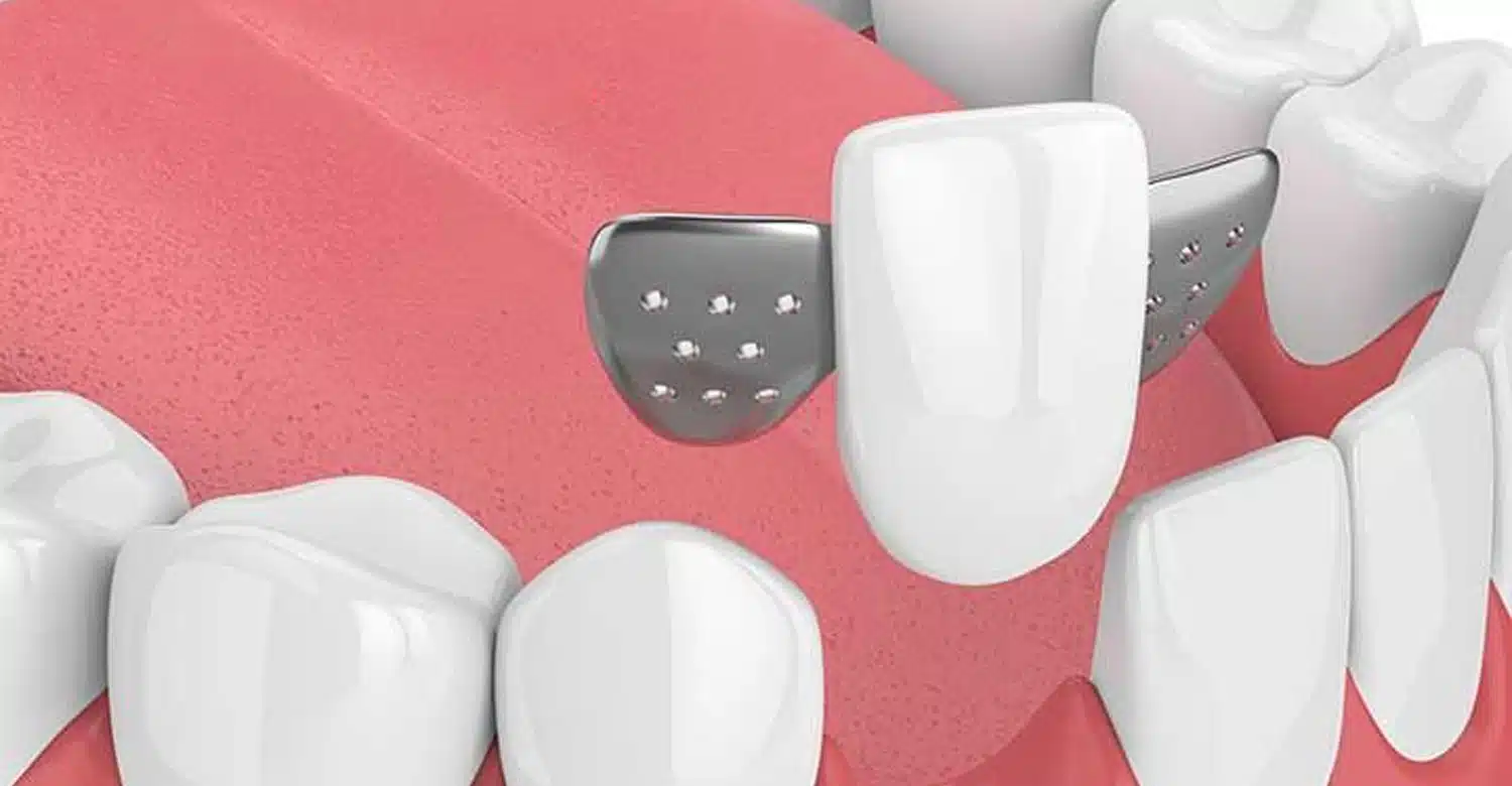 The Maryland Bridges What to Know About This Tooth Replacement Option