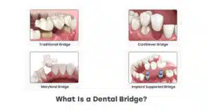 What Is a Dental Bridge