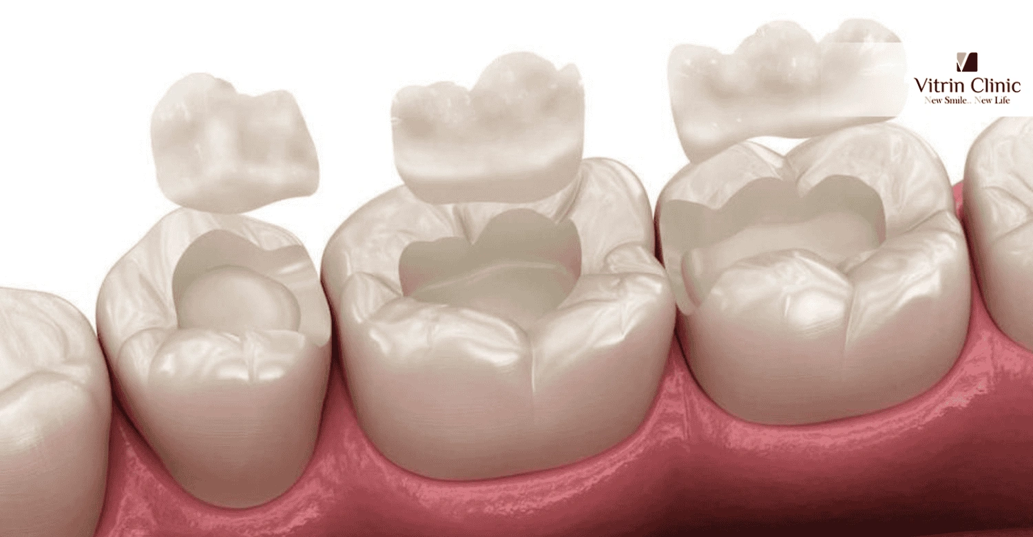 Expert Tips for Reducing Tooth Filling Costs in Turkey