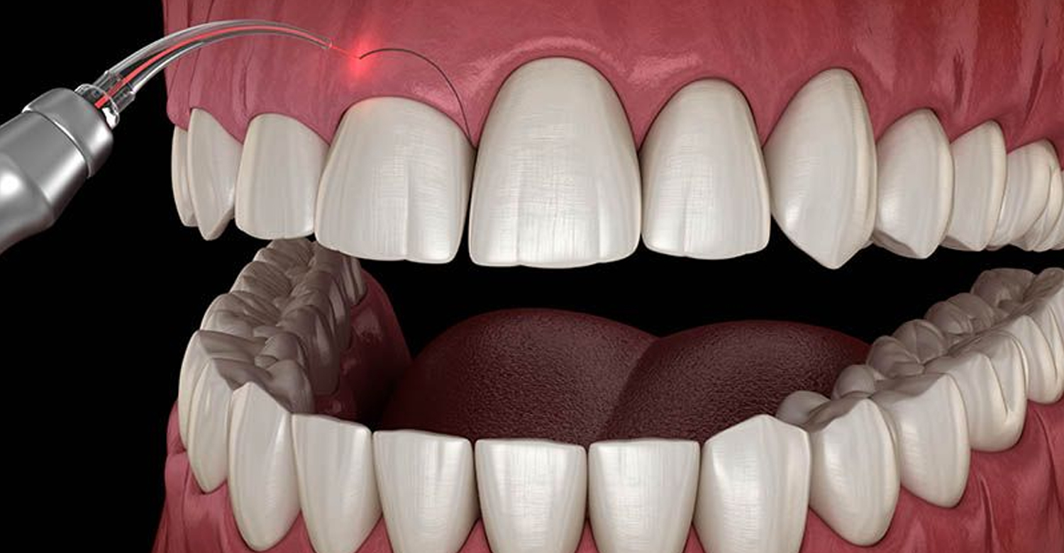 Gingivectomie