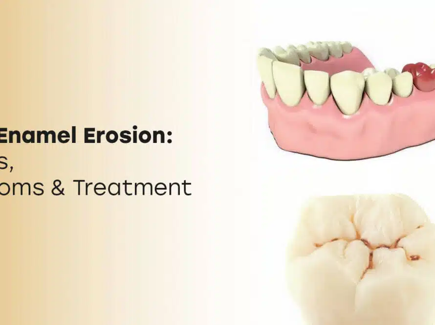 Tooth Enamel Erosion: Causes & Treatments in Turkey 2025?