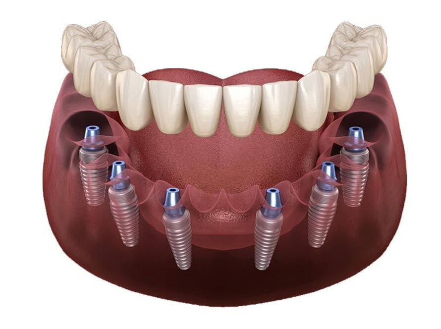 Implants dentaires All-on-6 : prix en Turquie (2025)