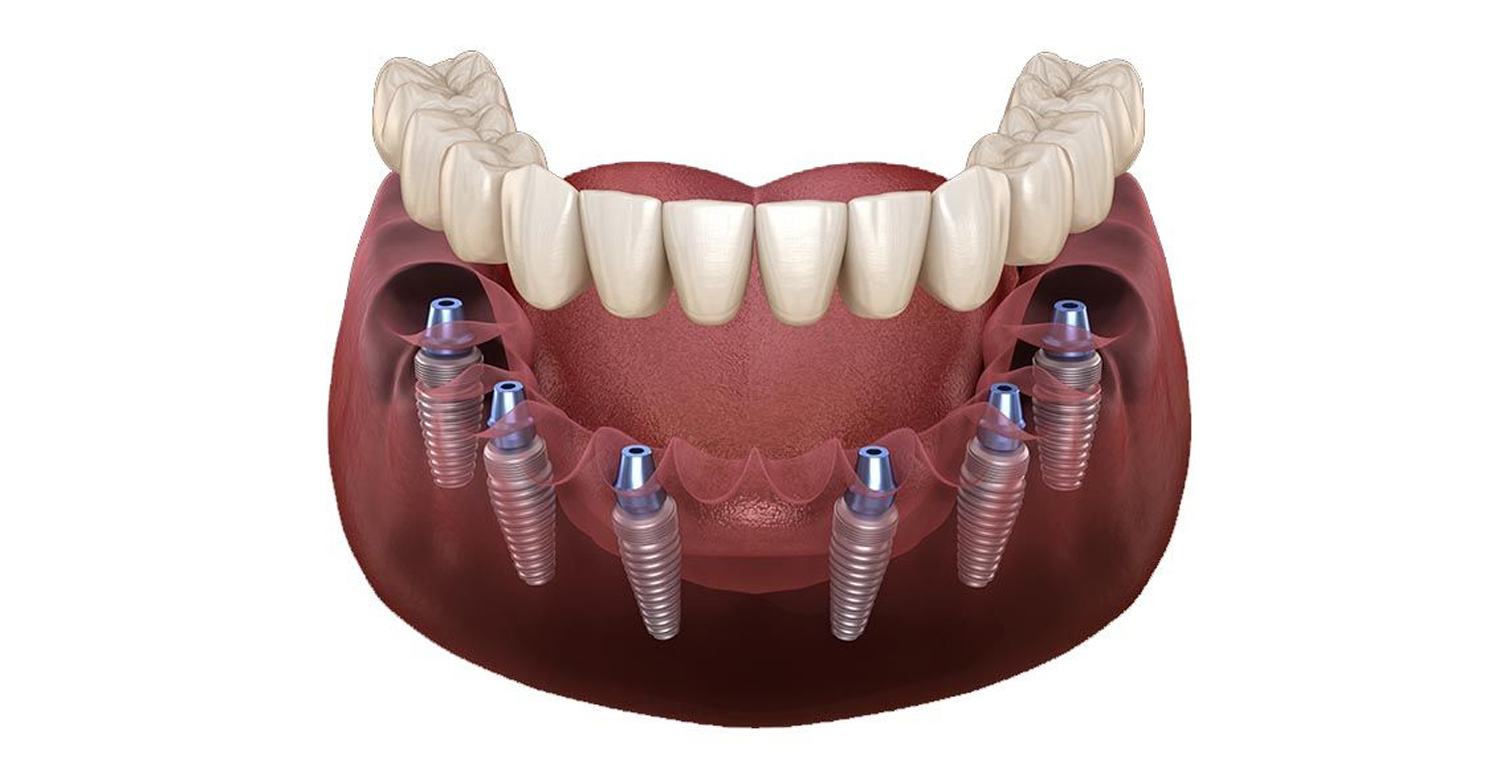 Precio de implantes dentales All-on-6 en Turquía (2025)