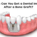 When Can You Get a Dental Implant After a Bone Graft?