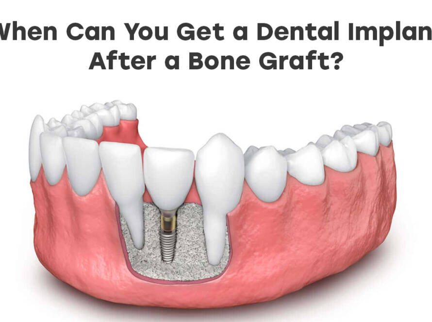When Can You Get a Dental Implant After a Bone Graft