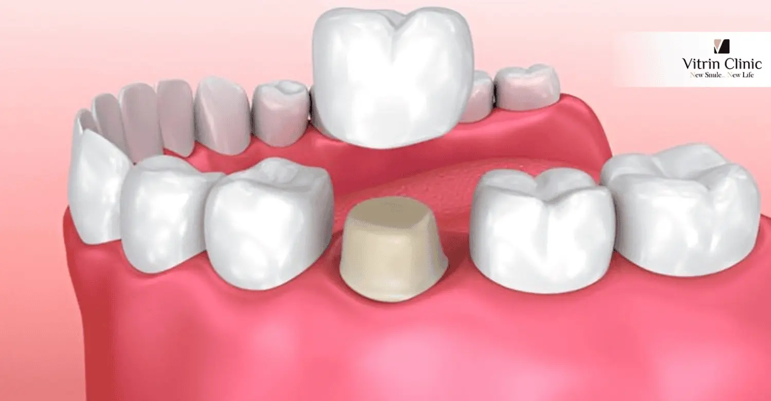How Much Does Dental Crown Repair Cost in Turkey?