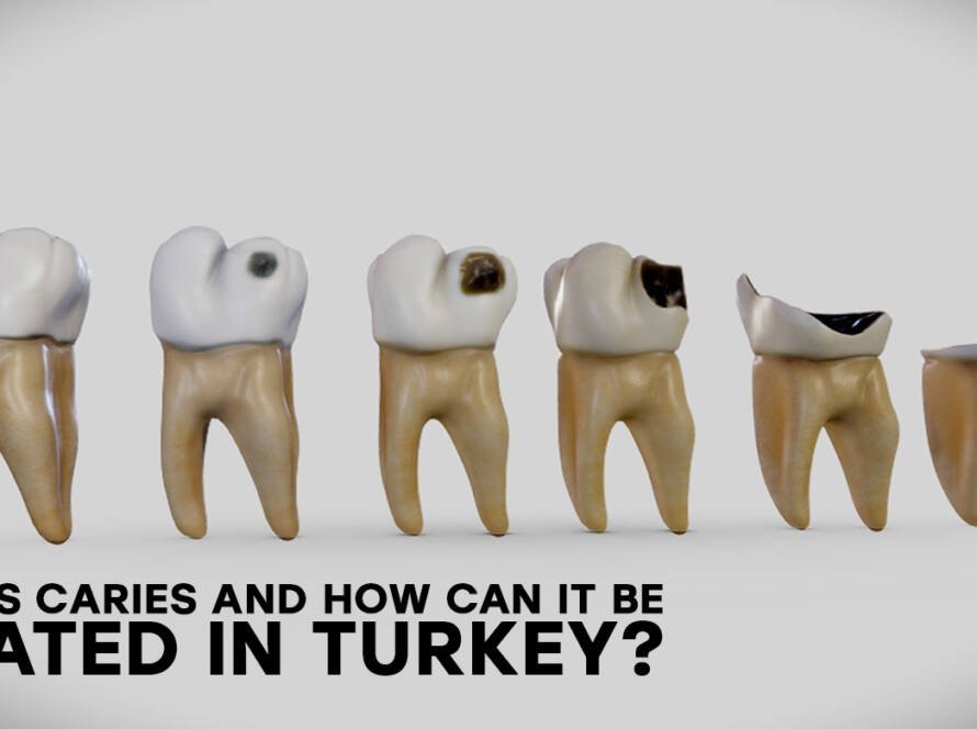 Caries