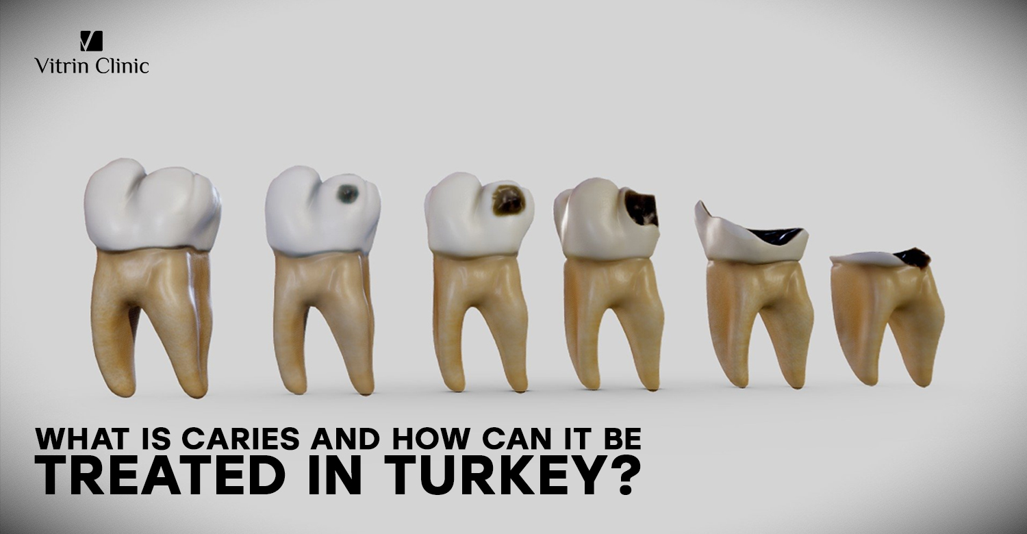 Caries