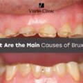 What Are the Main Causes of Bruxism in 2026?