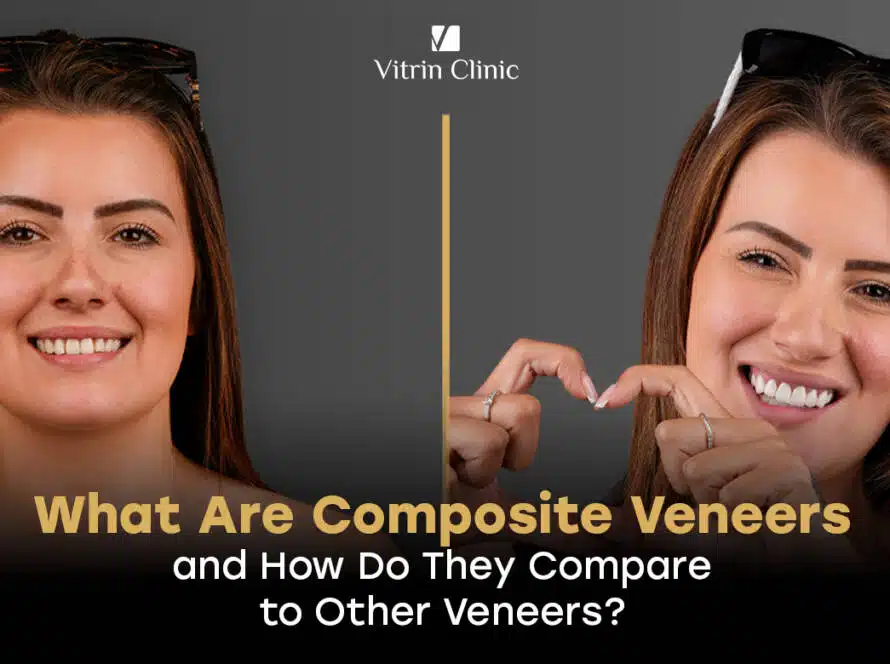 Composite veneers