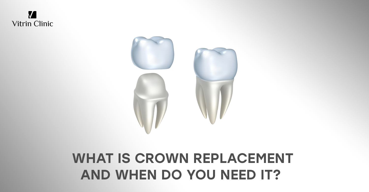 Crown replacement