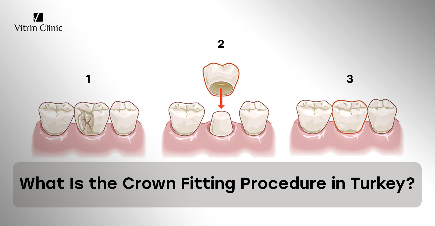 Crown fitting procedure