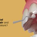 Is Dental Bonding Repair Failing You in 2026? Find Out What’s Going Wrong!