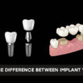 What Is the Difference Between Implant vs Bridge?
