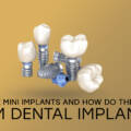 7 Powerful Benefits and Drawbacks: How Do Mini Implants Differ from Dental Implants?