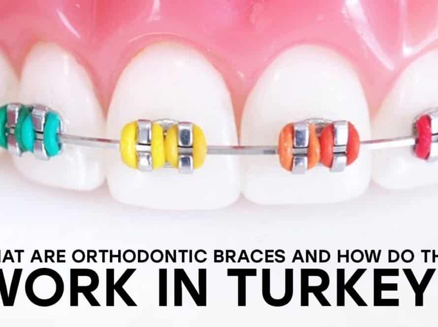 Orthodontic braces