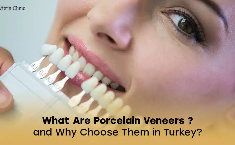 -Porcelain veneers