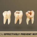 How Can You Effectively Prevent Rotten Teeth?
