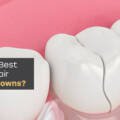 Top 5 Expert Tips for Repair of Broken Crowns in 2026 – Can They Really Be Fixed?