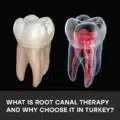 What Is Root Canal Therapy and Why Choose It in Turkey?