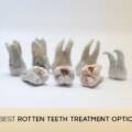 Top 7 Rotten Teeth Treatment Options: What Are the Best and Worst Solutions Today?