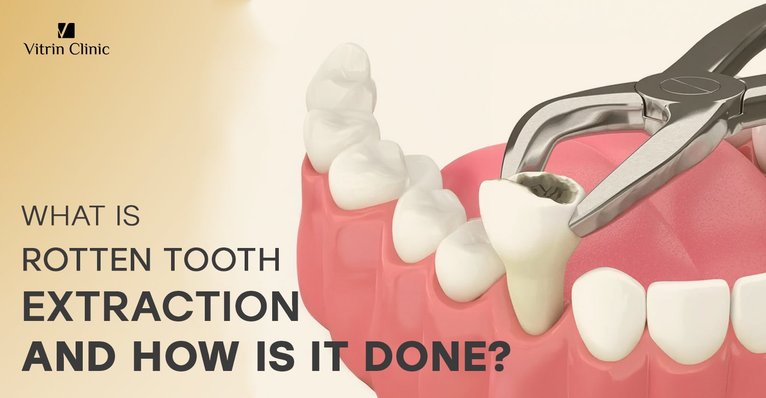 Rotten tooth extraction