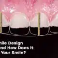 What Is Smile Design in Turkey and How Does It Transform Your Smile?