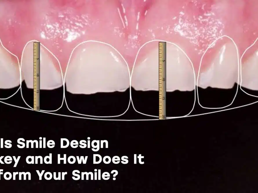 Smile design