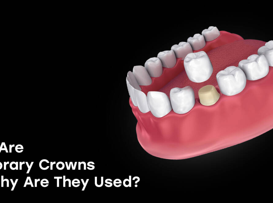 Temporary crowns
