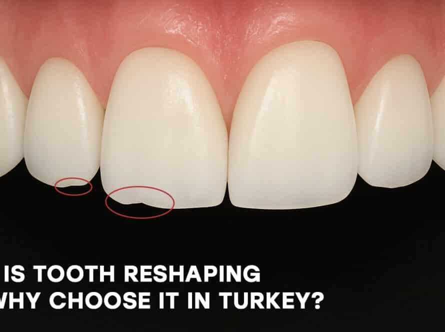 Tooth reshaping