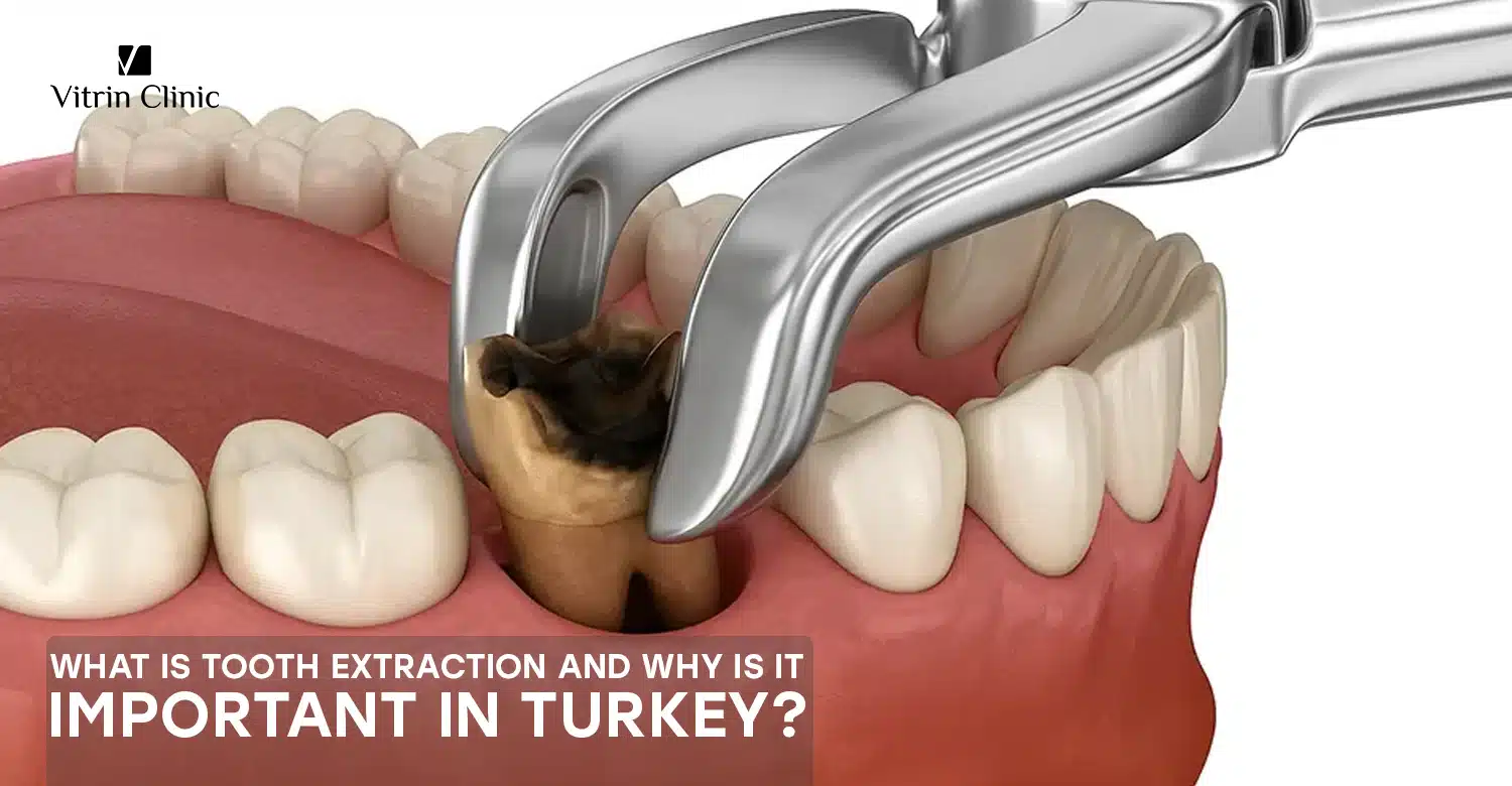 Tooth extraction