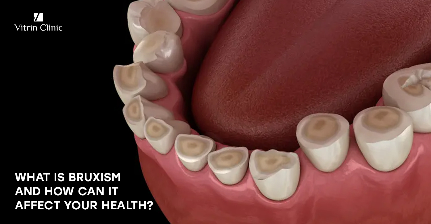 bruxism