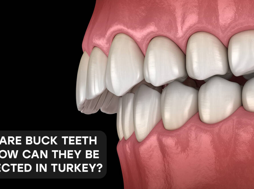 buck teeth