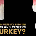 What Are the Key Differences Between Lumineers vs veneers?