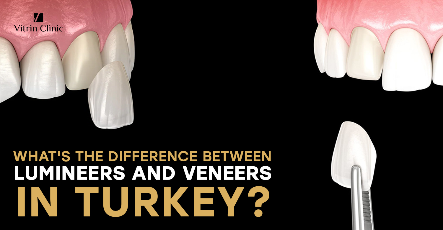 Lumineers vs veneers