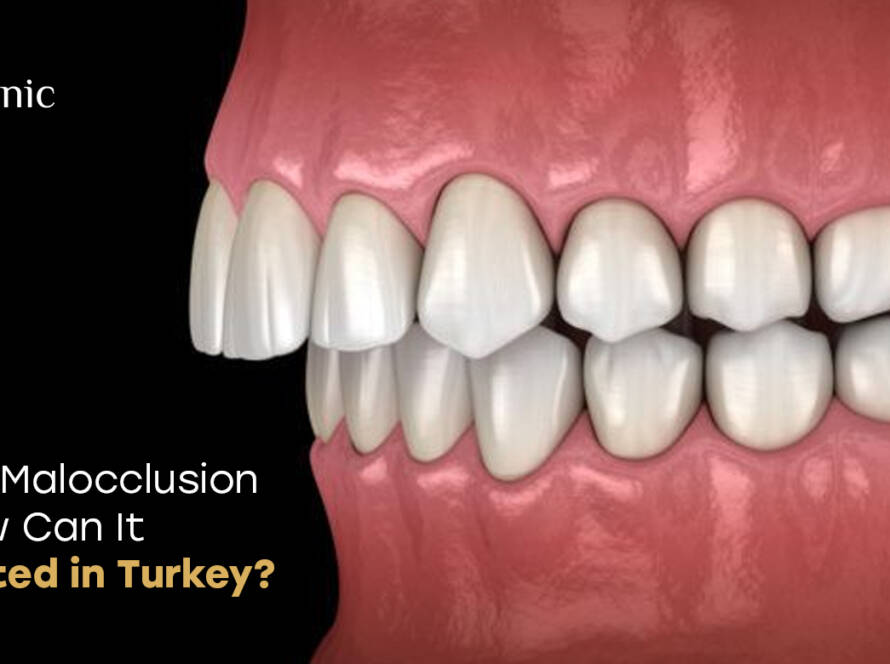 malocclusion