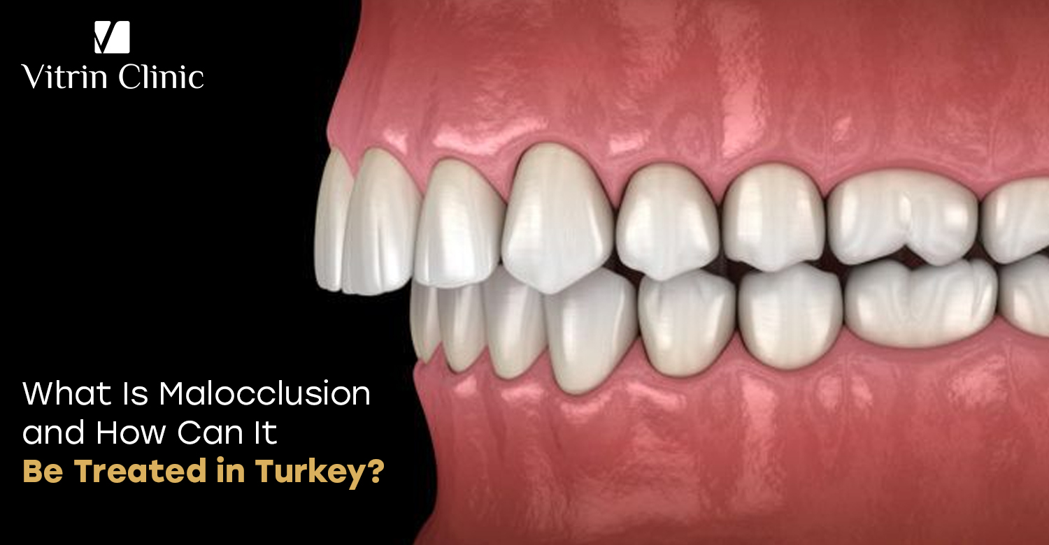 malocclusion