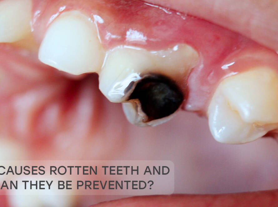 rotten teeth