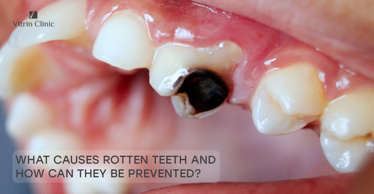 rotten teeth